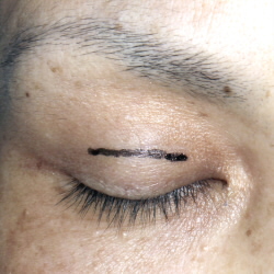 眼瞼下垂、部分切開、小切開、手術、傷目立たない、腫れない、切らない眼瞼下垂,　,デザイン